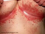 Vaginal Skin Infection